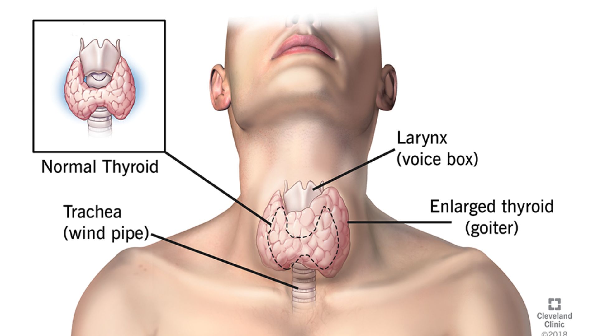 Hypothyroidism caused by Hashimoto’s thyroiditis is more common than you think